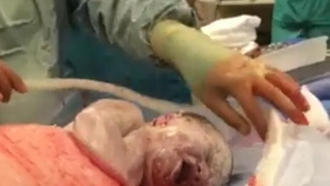 Brutális videó - az újszülött maga mászik ki anyja hasából