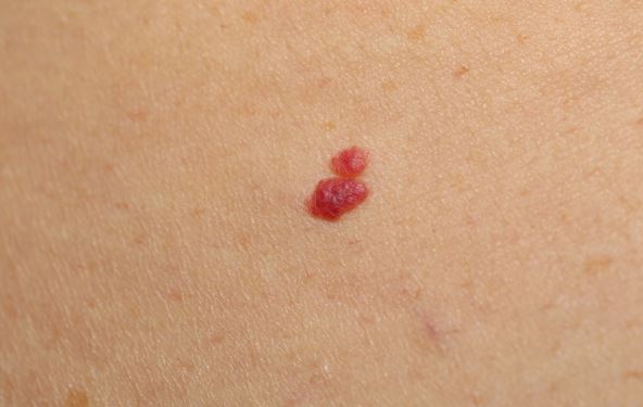 Rákelőző állapot a bőrön: a Paget-kór